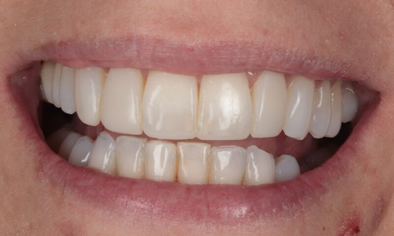 After - Lakewood Dental
