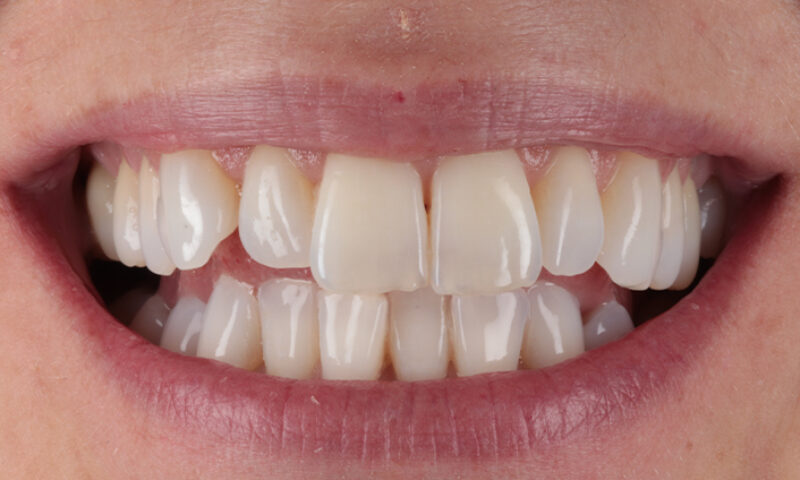 Before - Lakewood Dental