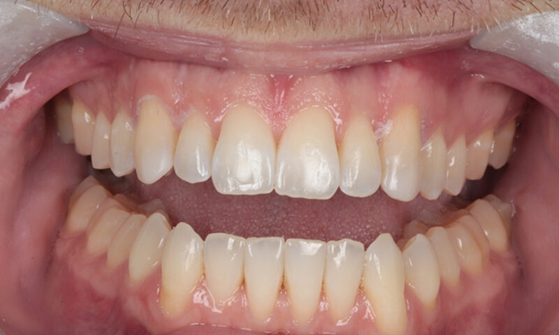 After - Lakewood Dental