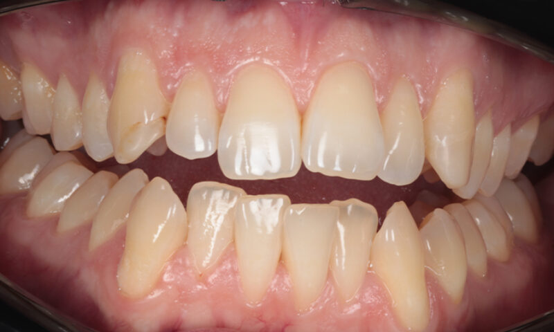 Before - Lakewood Dental