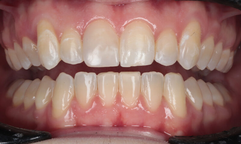 After - Lakewood Dental