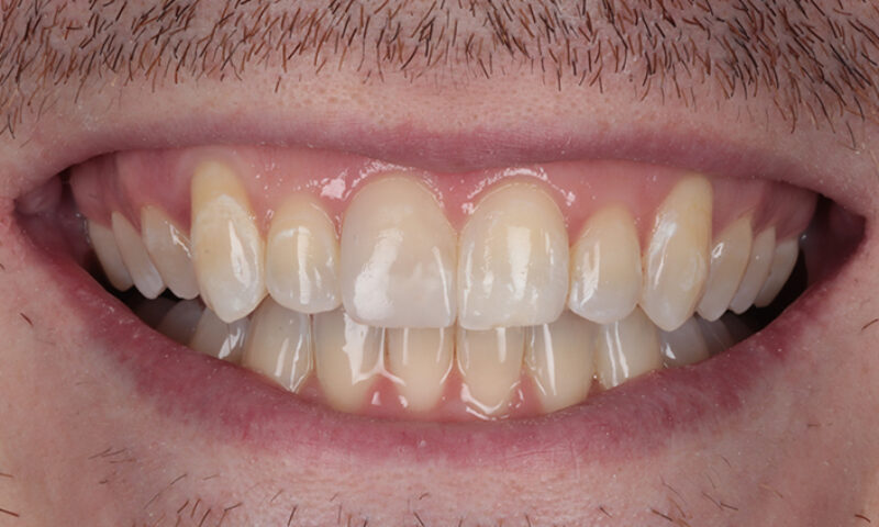 After - Lakewood Dental