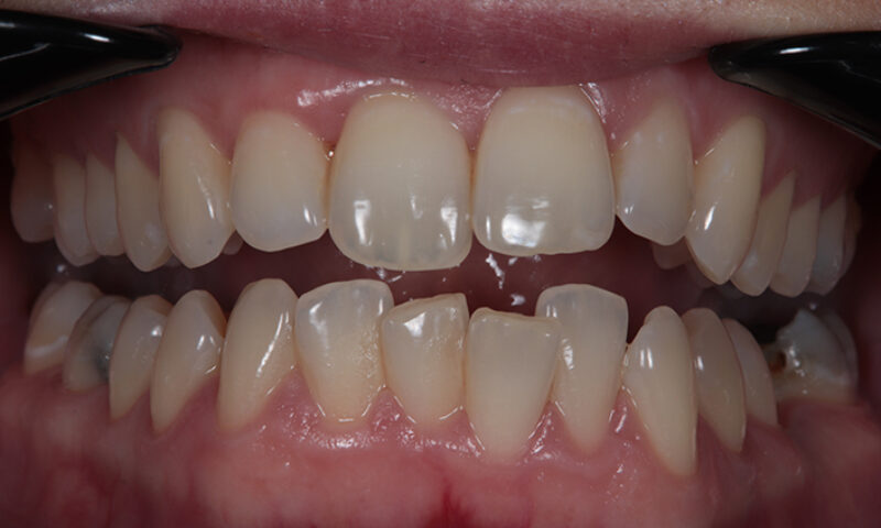 Before - Lakewood Dental