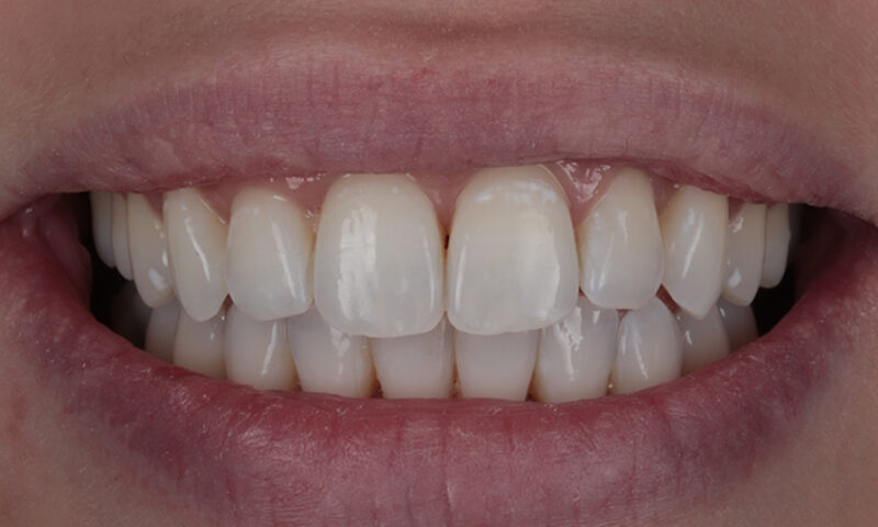 After - Lakewood Dental