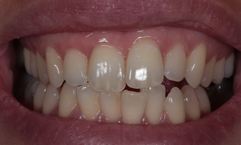 Before - Lakewood Dental