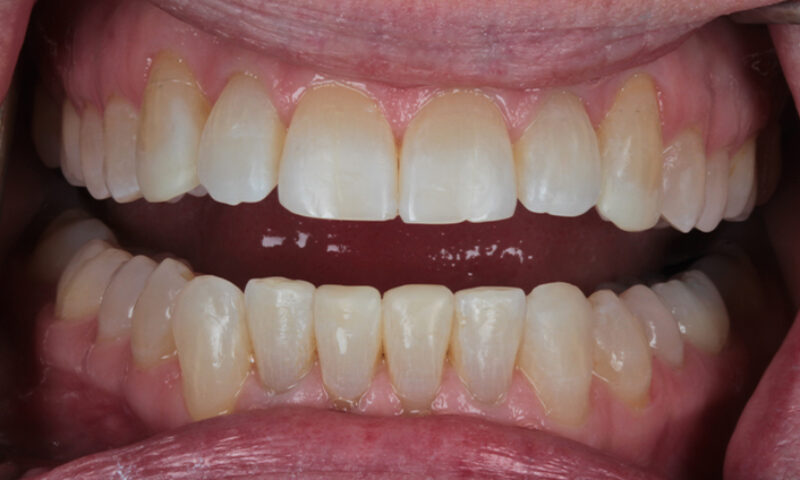 After - Lakewood Dental