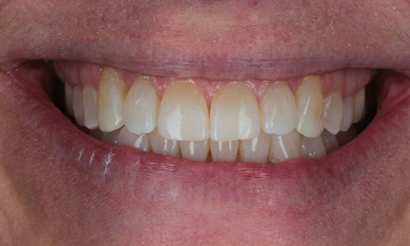 After - Lakewood Dental