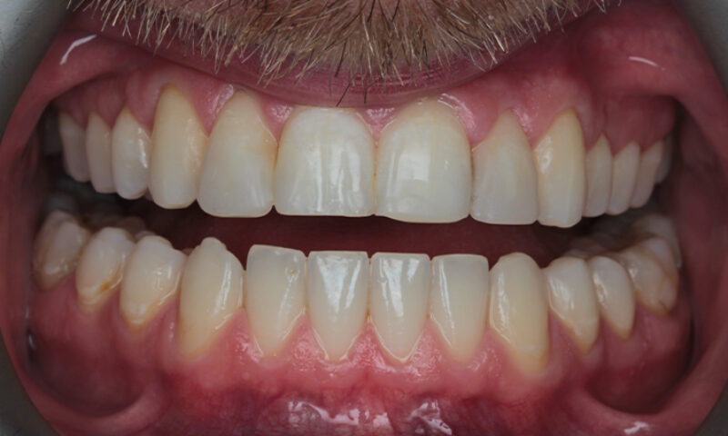 After - Lakewood Dental