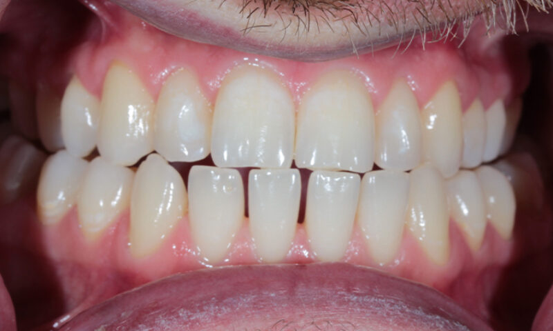 Before - Lakewood Dental