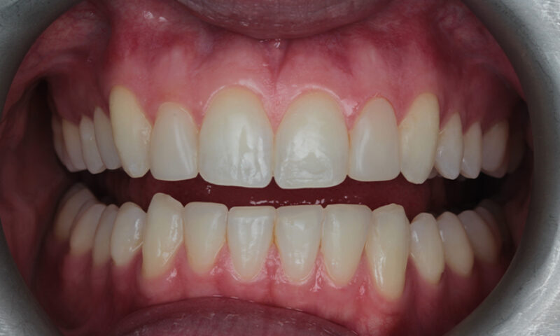 After - Lakewood Dental