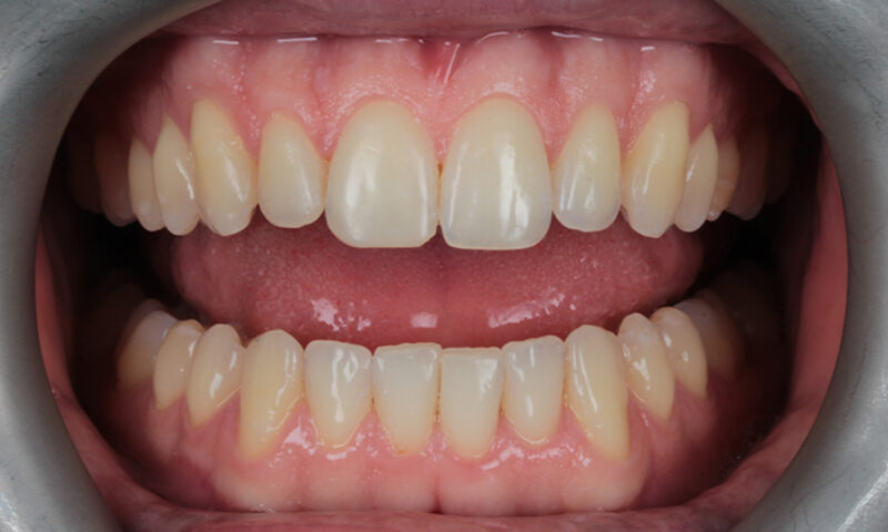 Before - Lakewood Dental