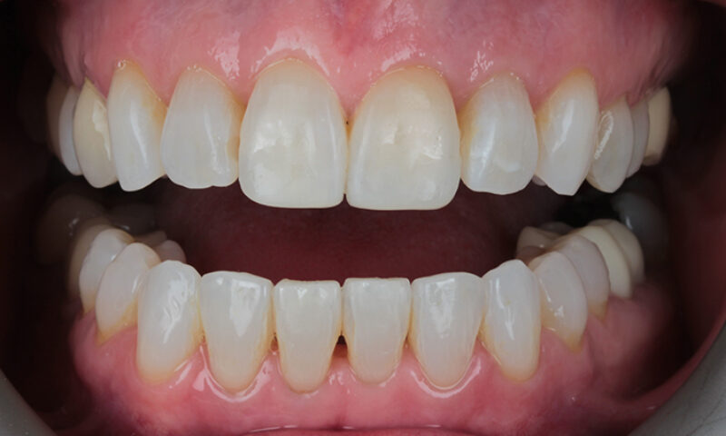 After - Lakewood Dental