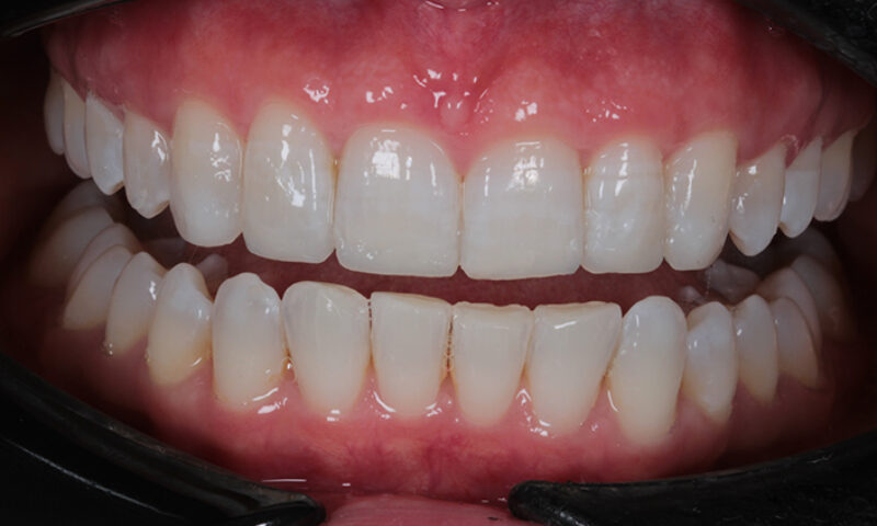 After - Lakewood Dental