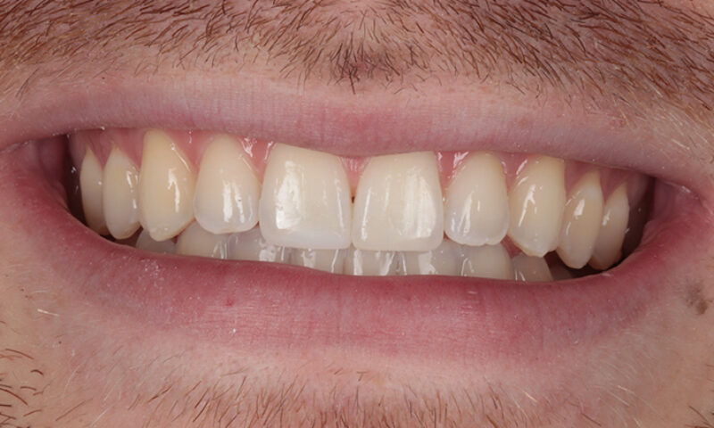 After - Lakewood Dental