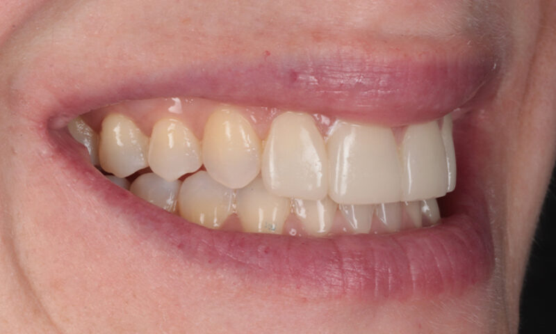 After - Lakewood Dental