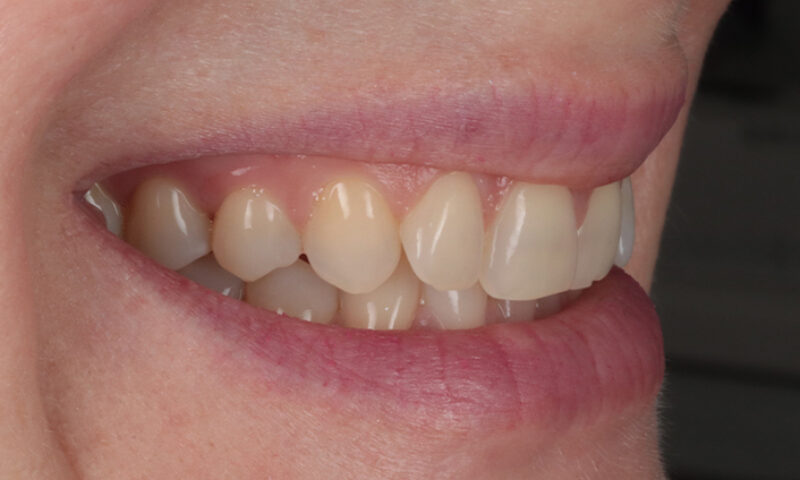 Before - Lakewood Dental