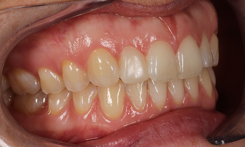 After - Lakewood Dental