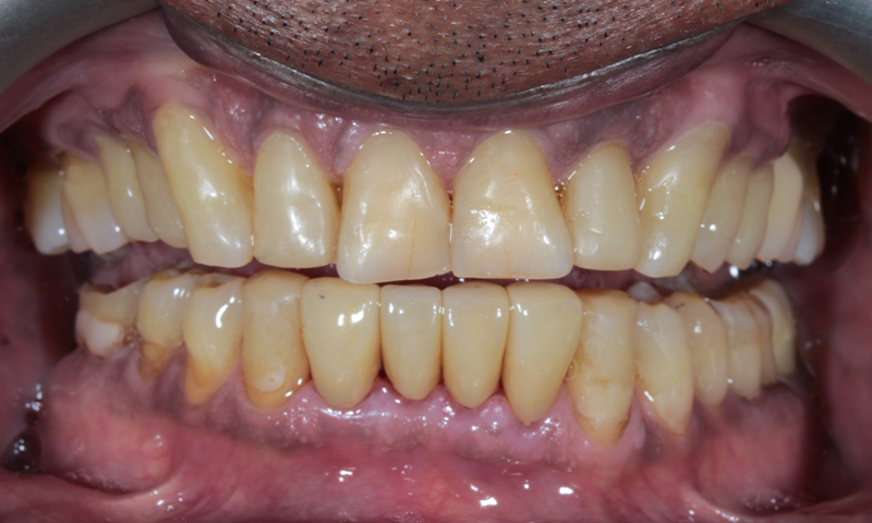 After - Lakewood Dental