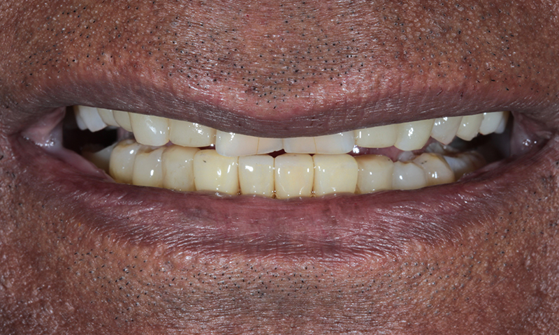 After - Lakewood Dental