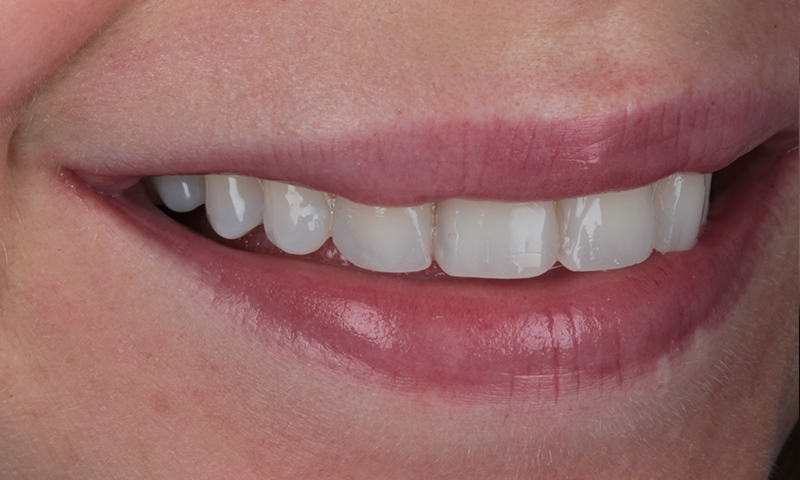 After - Lakewood Dental