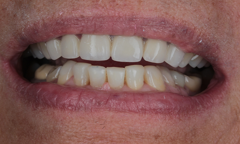 After - Lakewood Dental