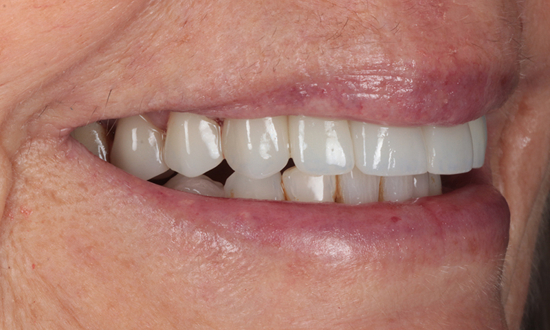 After - Lakewood Dental