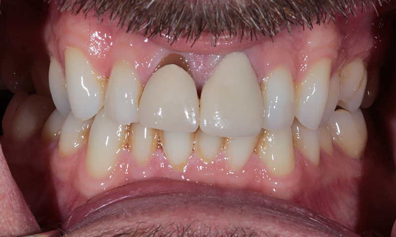 Before - Lakewood Dental