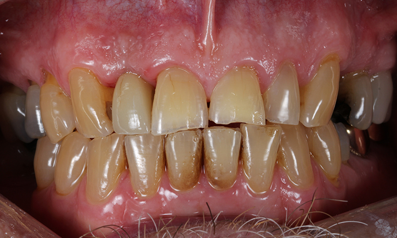 After - Lakewood Dental