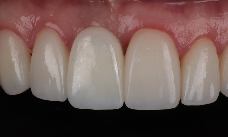 After - Lakewood Dental