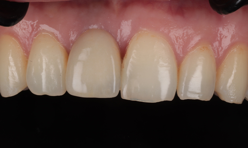 Before - Lakewood Dental
