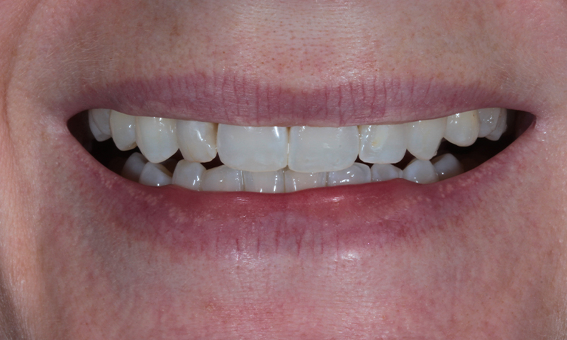 After - Lakewood Dental