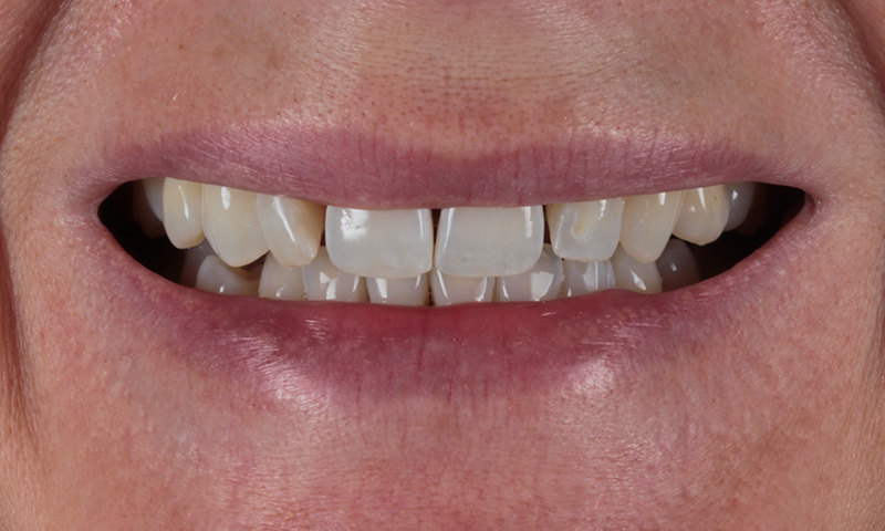 Before - Lakewood Dental