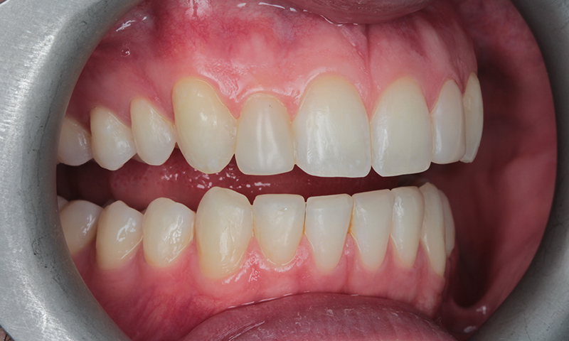 After - Lakewood Dental