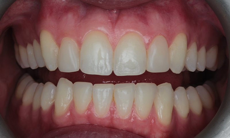 After - Lakewood Dental
