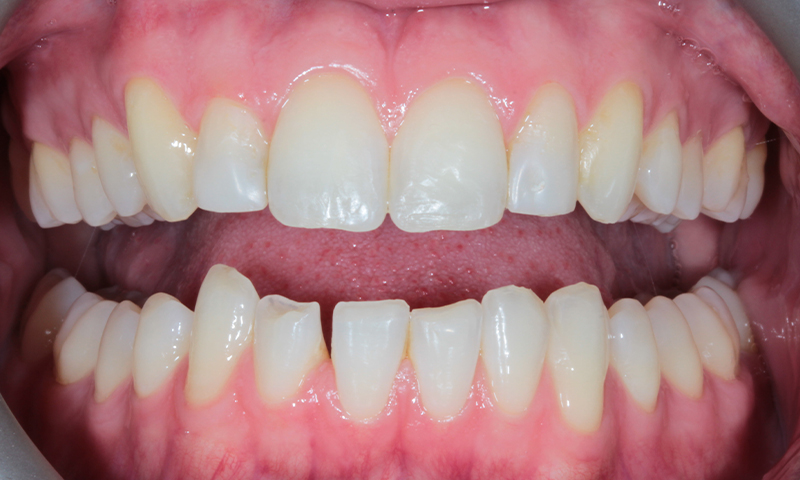 Before - Lakewood Dental