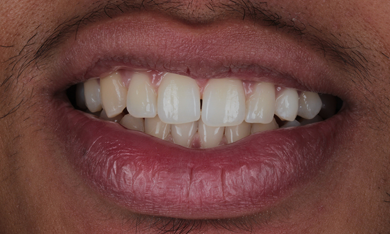 After - Lakewood Dental