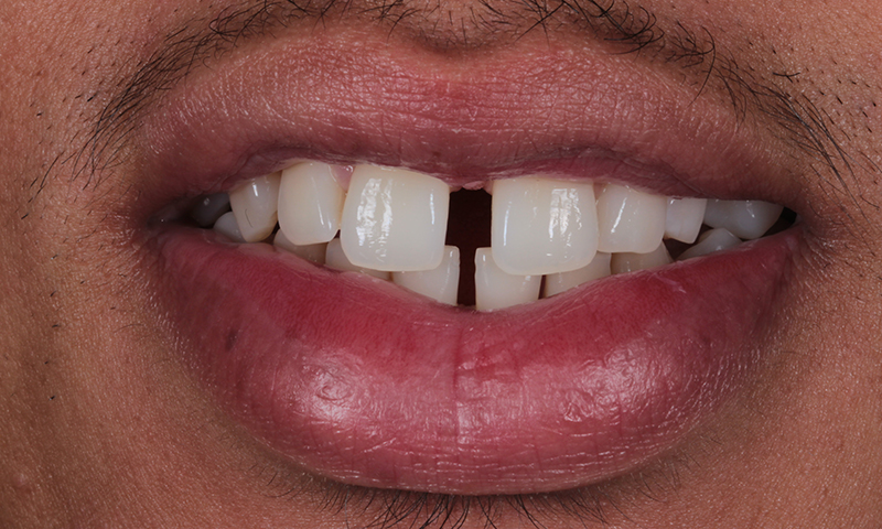 Before - Lakewood Dental