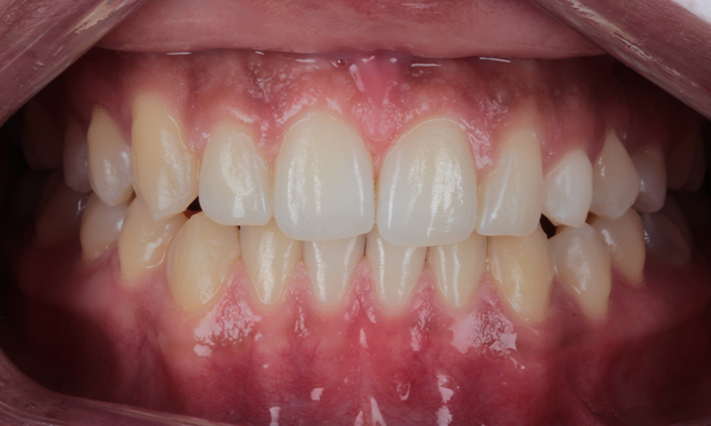 After - Lakewood Dental
