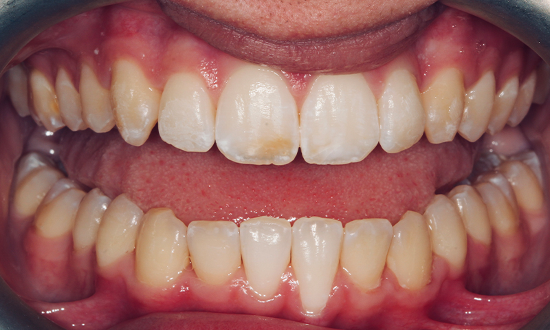 After - Lakewood Dental