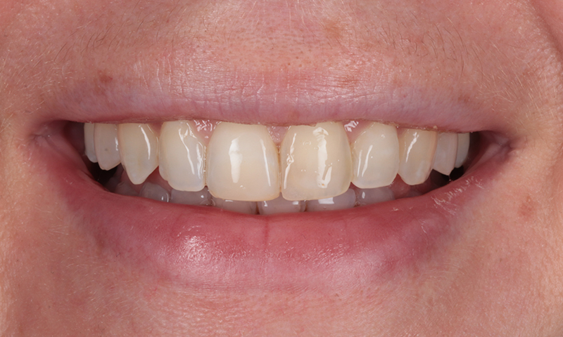 After - Lakewood Dental