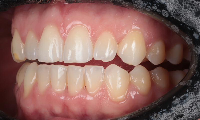 After - Lakewood Dental