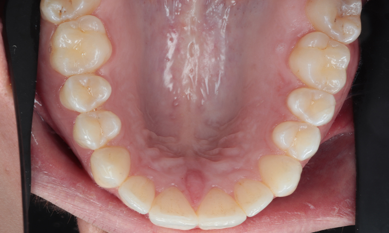 After - Lakewood Dental