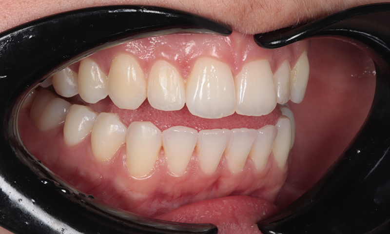 After - Lakewood Dental