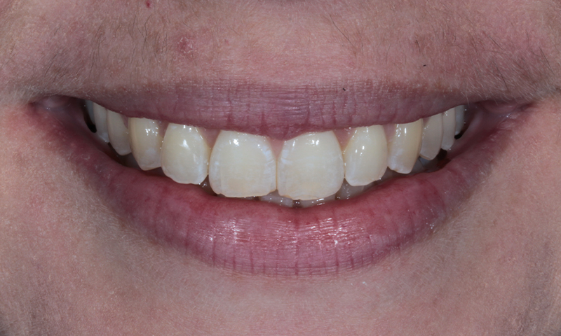 After - Lakewood Dental