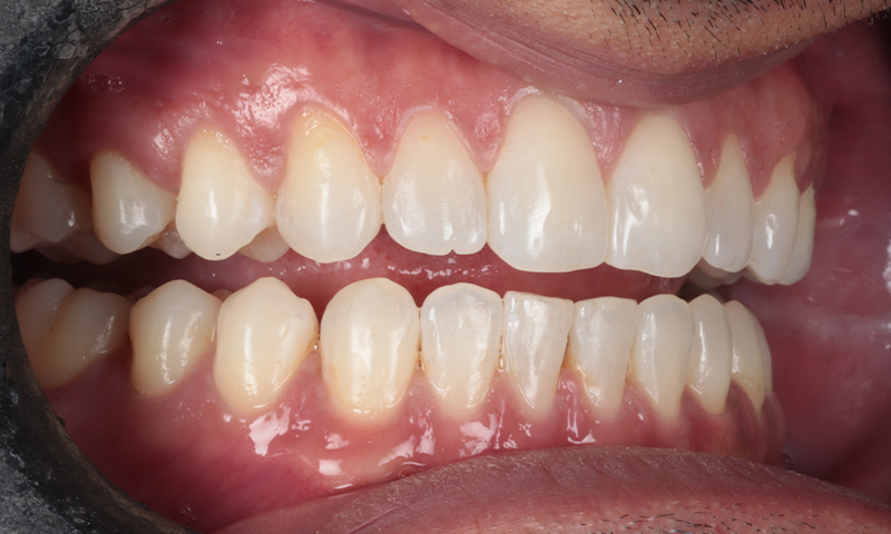 After - Lakewood Dental