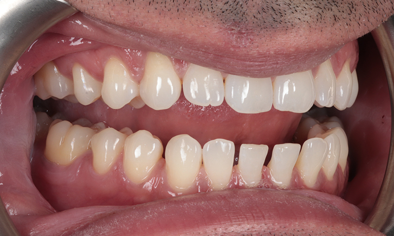 Before - Lakewood Dental