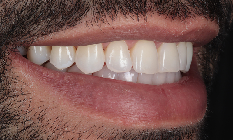 After - Lakewood Dental