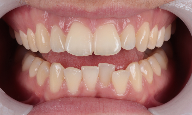 Before - Lakewood Dental