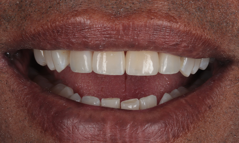 After - Lakewood Dental