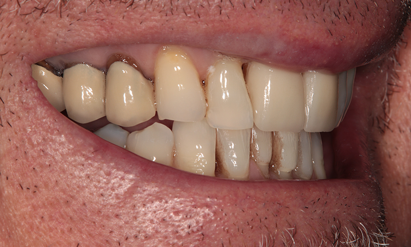 After - Lakewood Dental